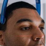 Best Laser for Acne Scars: