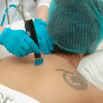 laser treatment for toenail fungus