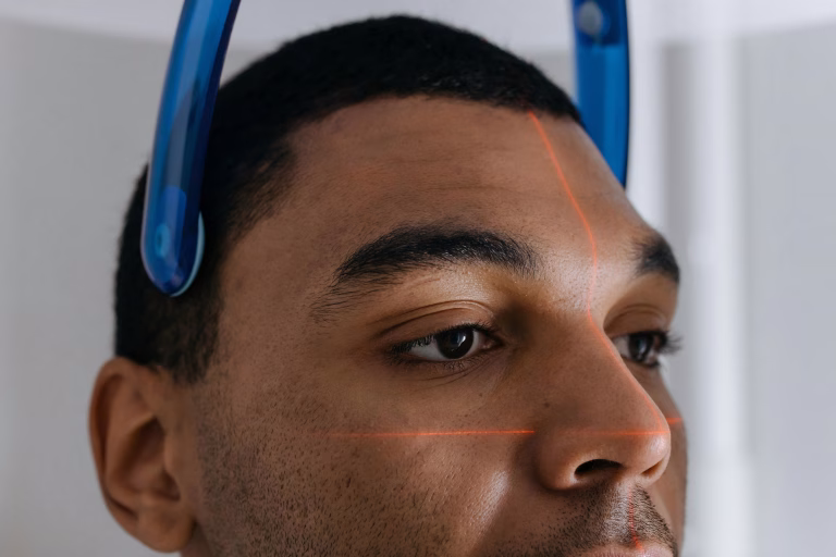 Best Laser for Acne Scars: