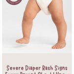 Severe Diaper Rash
